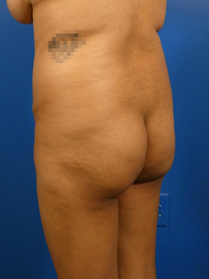 Brazilian Butt Lift Before & After Gallery - Patient 890234 - Image 3