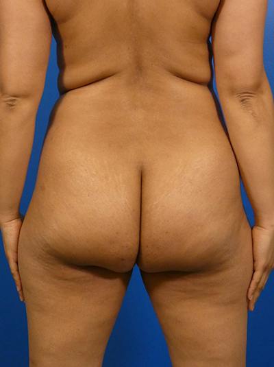 Brazilian Butt Lift Before & After Gallery - Patient 339568 - Image 1