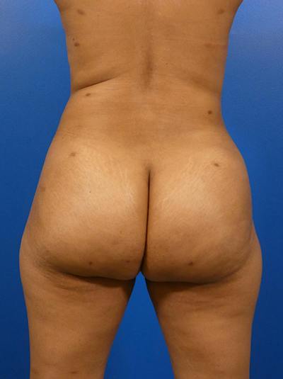 Brazilian Butt Lift Before & After Gallery - Patient 339568 - Image 2