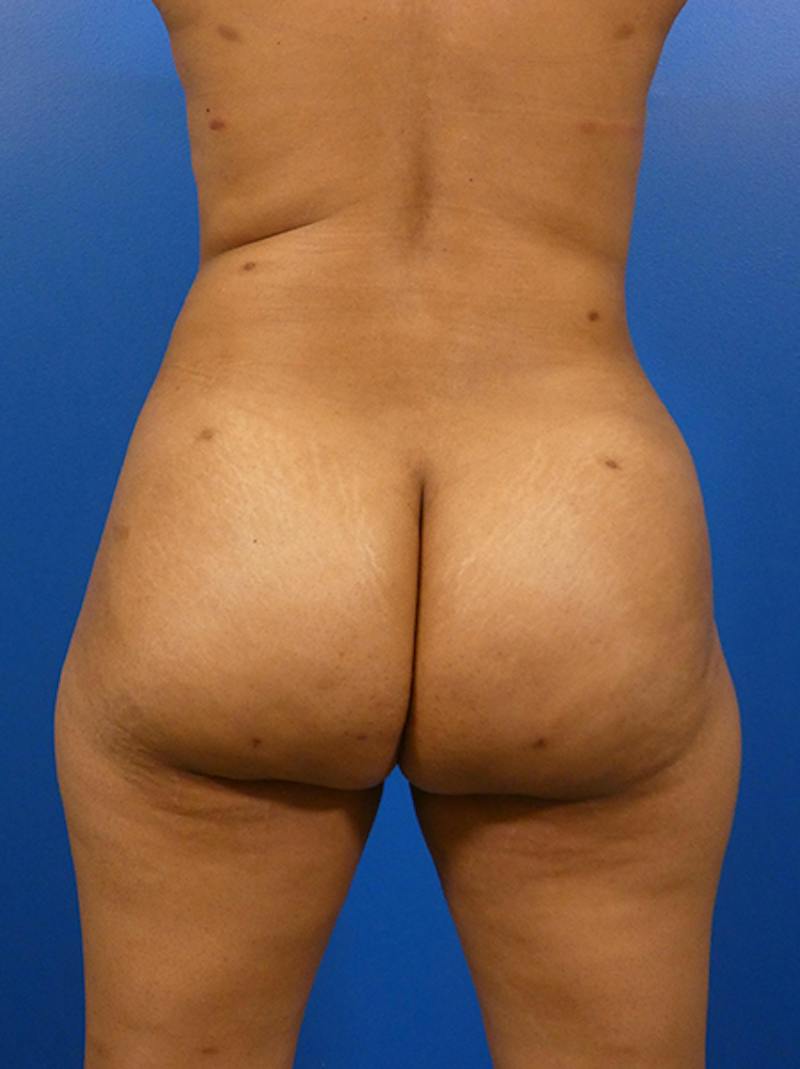 Brazilian Butt Lift Before & After Gallery - Patient 339568 - Image 2