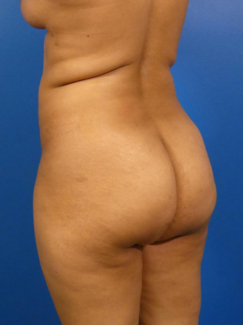 Brazilian Butt Lift Before & After Gallery - Patient 339568 - Image 3
