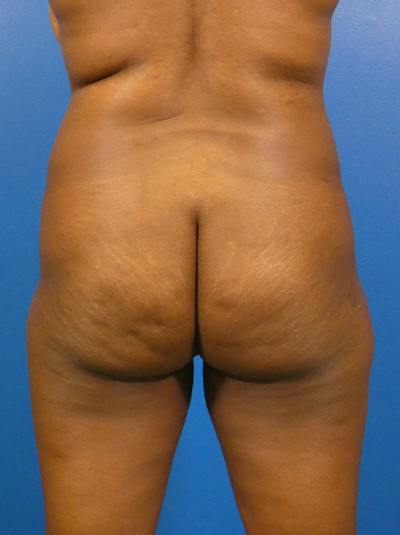 Brazilian Butt Lift Before & After Gallery - Patient 135795 - Image 1