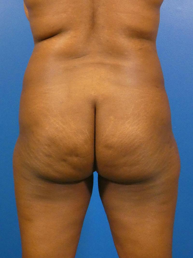 Brazilian Butt Lift Before & After Gallery - Patient 135795 - Image 1