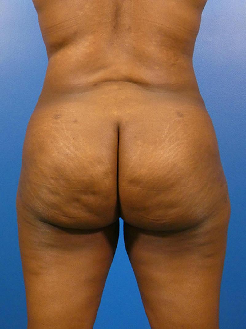 Brazilian Butt Lift Before & After Gallery - Patient 135795 - Image 2