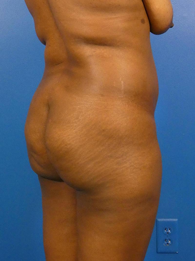 Brazilian Butt Lift Before & After Gallery - Patient 135795 - Image 3