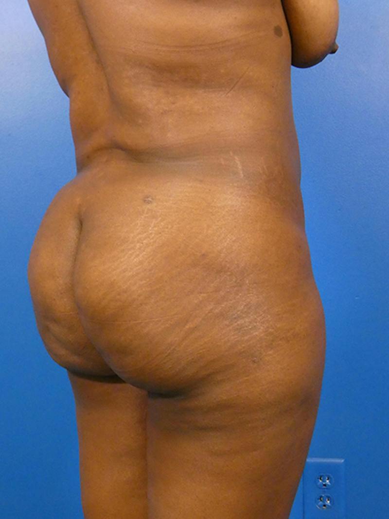 Brazilian Butt Lift Before & After Gallery - Patient 135795 - Image 4