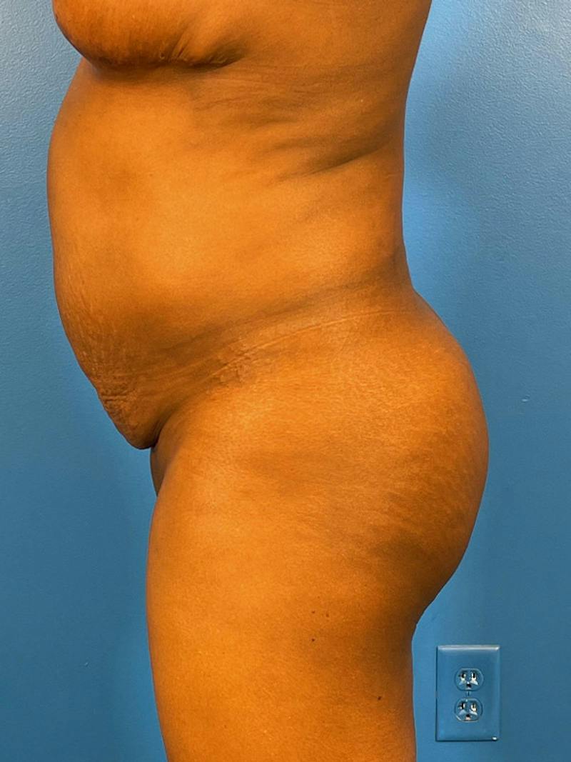 Brazilian Butt Lift Before & After Gallery - Patient 392481 - Image 5
