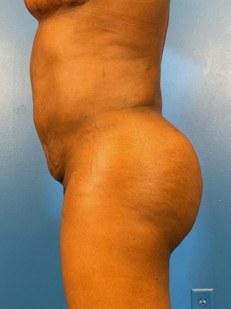 Brazilian Butt Lift Before & After Gallery - Patient 392481 - Image 6