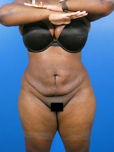 Liposuction Before & After Gallery - Patient 123110 - Image 2