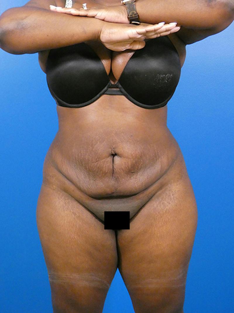 Liposuction Before & After Gallery - Patient 123110 - Image 2