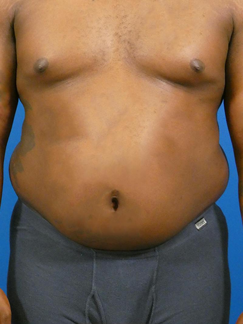 Liposuction Before & After Gallery - Patient 110884 - Image 1
