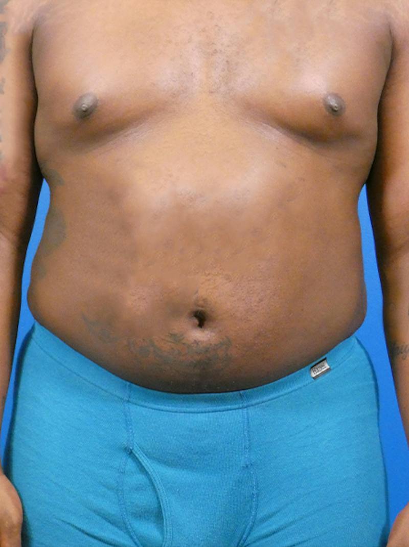 Liposuction Before & After Gallery - Patient 110884 - Image 2