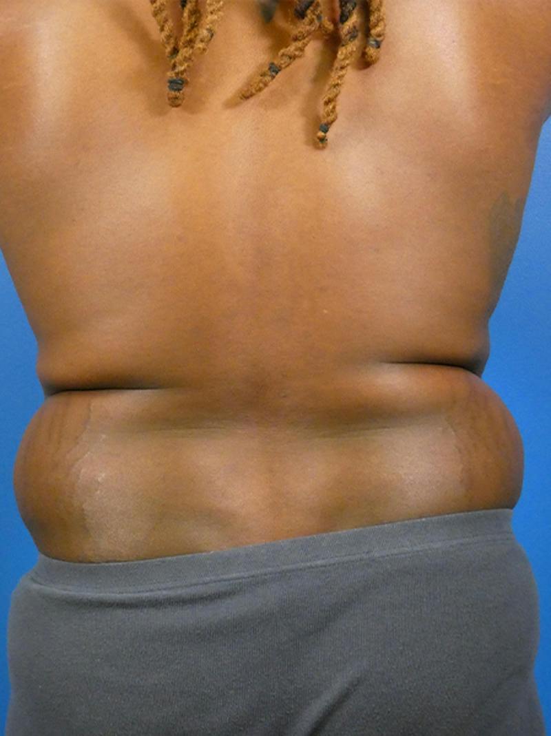 Liposuction Before & After Gallery - Patient 110884 - Image 3