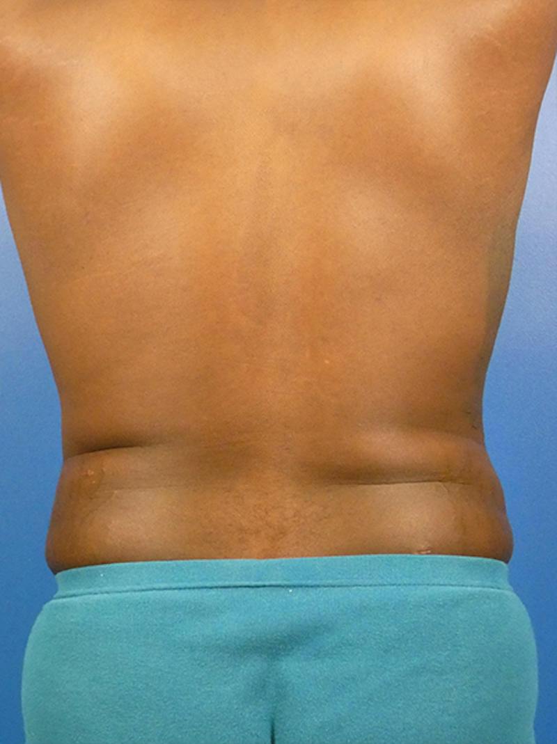 Liposuction Before & After Gallery - Patient 110884 - Image 4