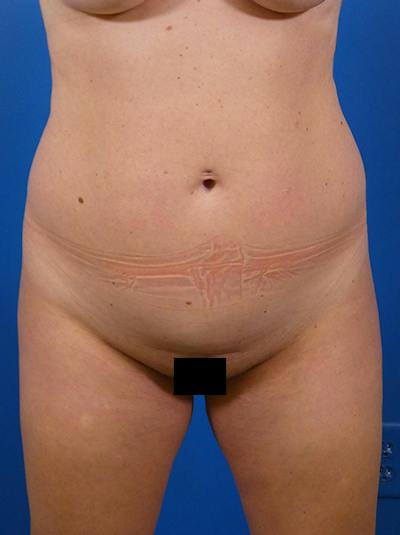 Liposuction Before & After Gallery - Patient 954396 - Image 1