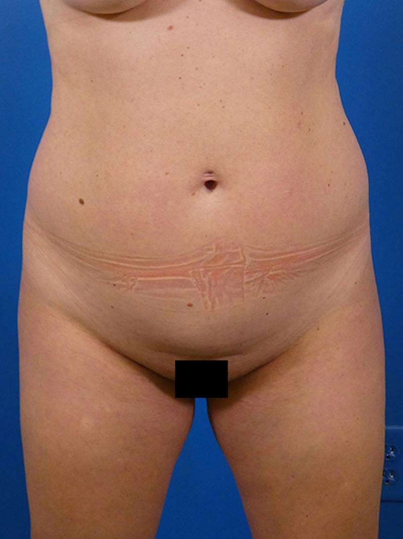 Liposuction Before & After Gallery - Patient 954396 - Image 1