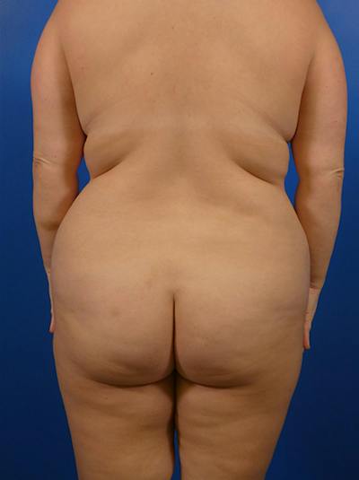 Liposuction Before & After Gallery - Patient 423465 - Image 1