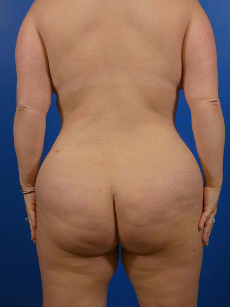 Liposuction Before & After Gallery - Patient 423465 - Image 2