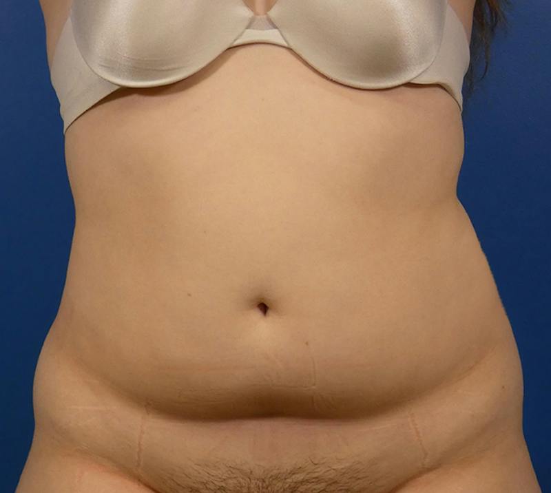 Liposuction Before & After Gallery - Patient 156664 - Image 1