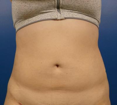 Liposuction Before & After Gallery - Patient 156664 - Image 2