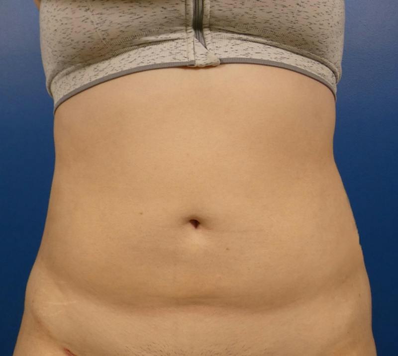 Liposuction Before & After Gallery - Patient 156664 - Image 2
