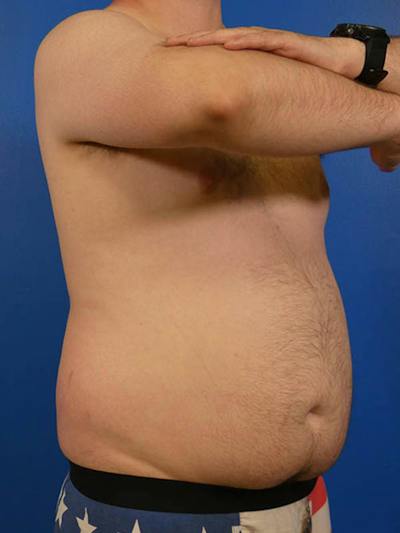 Liposuction Before & After Gallery - Patient 334934 - Image 1