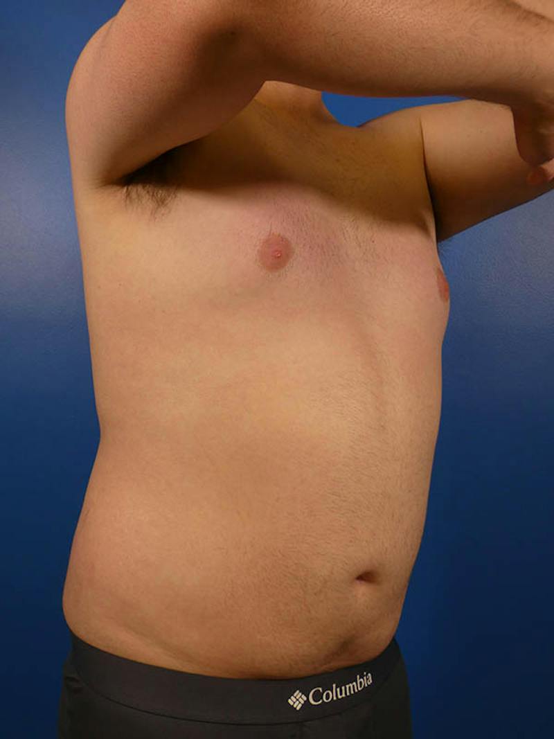 Liposuction Before & After Gallery - Patient 334934 - Image 2