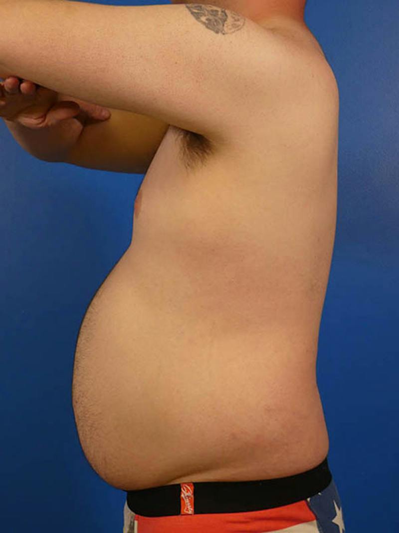 Liposuction Before & After Gallery - Patient 334934 - Image 3