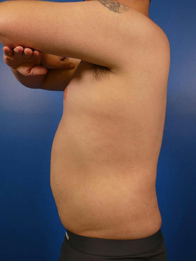 Liposuction Before & After Gallery - Patient 334934 - Image 4