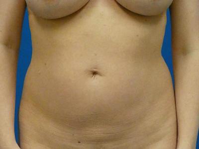 Liposuction Before & After Gallery - Patient 155148 - Image 1