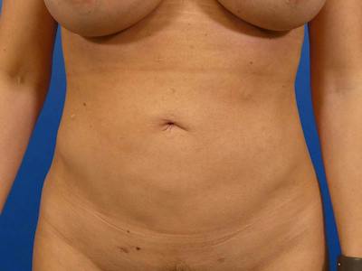 Liposuction Before & After Gallery - Patient 155148 - Image 2