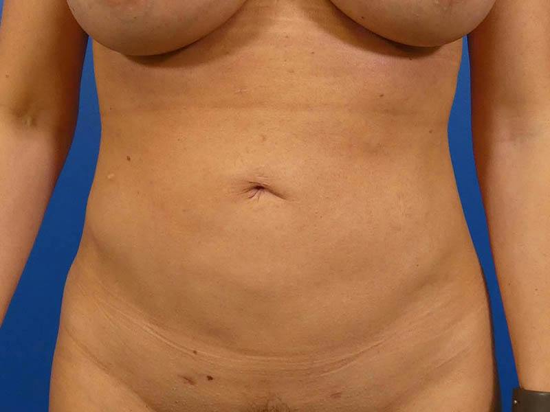 Liposuction Before & After Gallery - Patient 155148 - Image 2