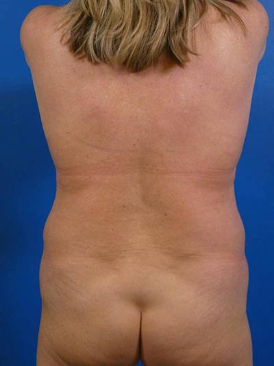 Liposuction Before & After Gallery - Patient 204286 - Image 1