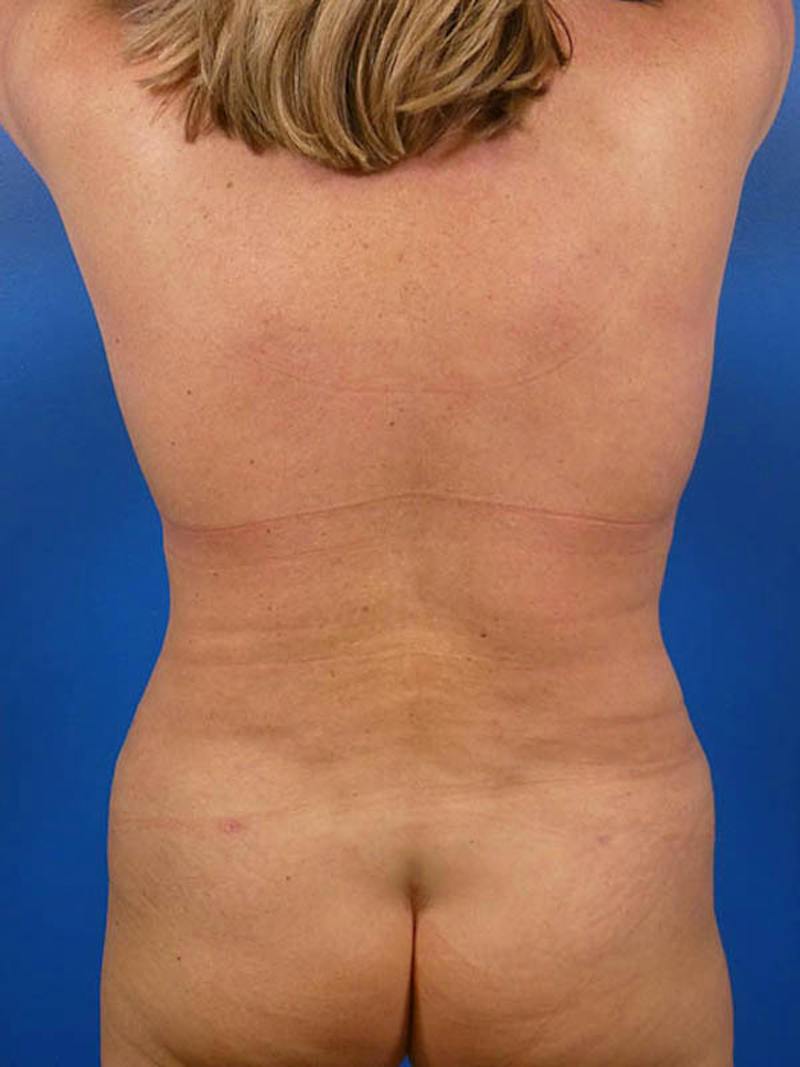 Liposuction Before & After Gallery - Patient 204286 - Image 2