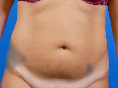 Liposuction Before & After Gallery - Patient 184098 - Image 1