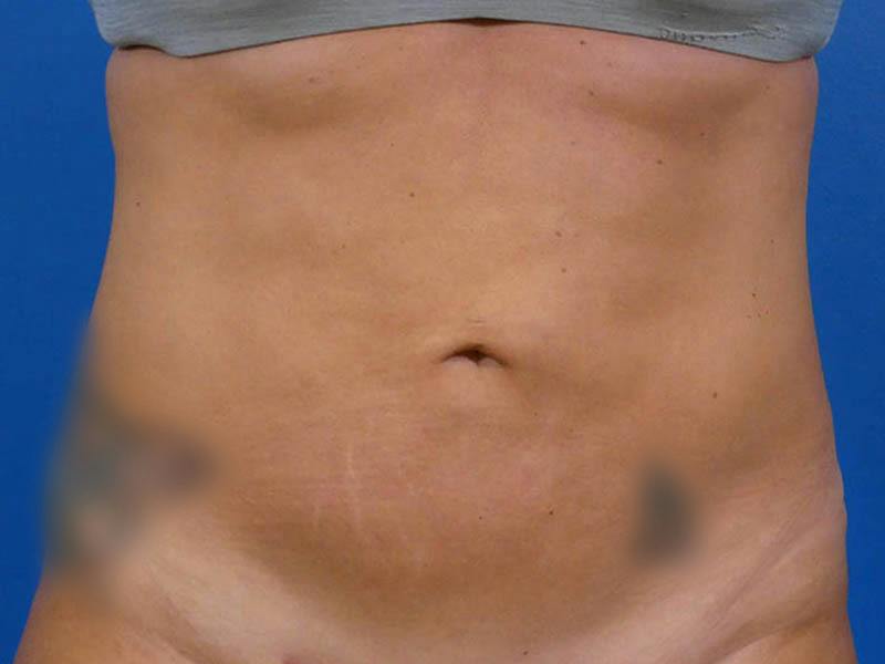 Liposuction Before & After Gallery - Patient 184098 - Image 2