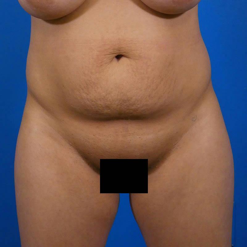 Liposuction Before & After Gallery - Patient 179300 - Image 1