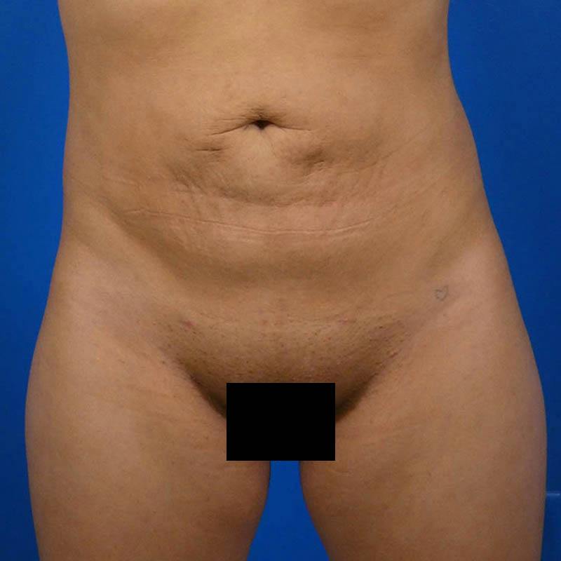 Liposuction Before & After Gallery - Patient 179300 - Image 2