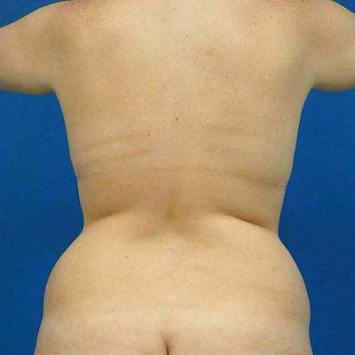 Liposuction Before & After Gallery - Patient 314263 - Image 1