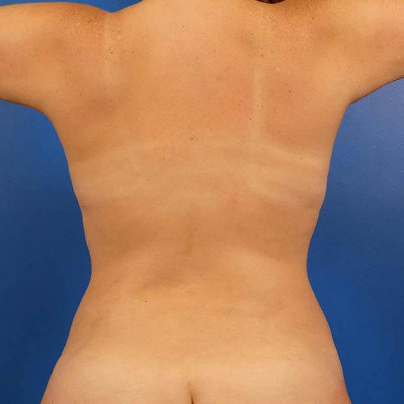 Liposuction Before & After Gallery - Patient 314263 - Image 2