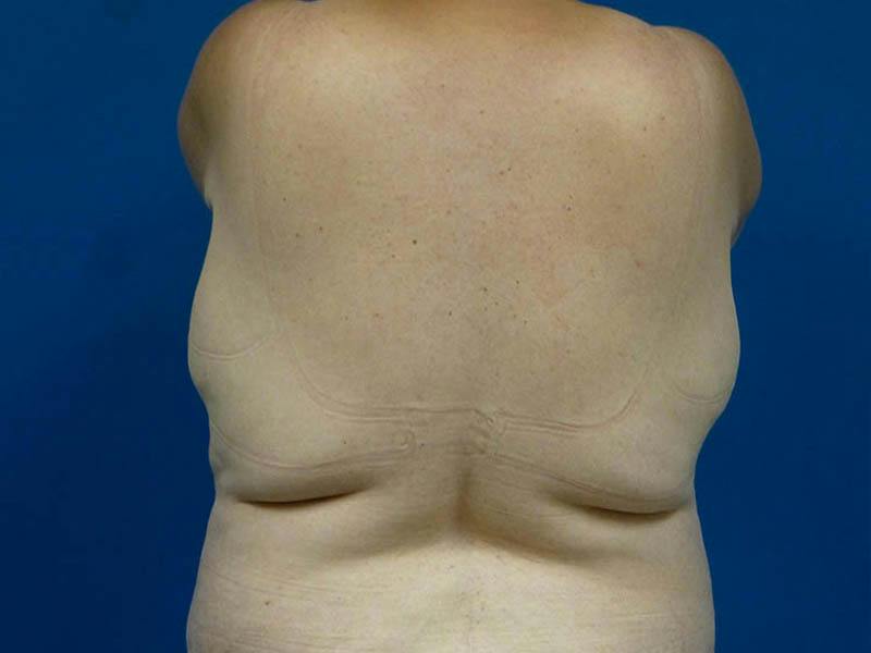 Liposuction Before & After Gallery - Patient 196680 - Image 1