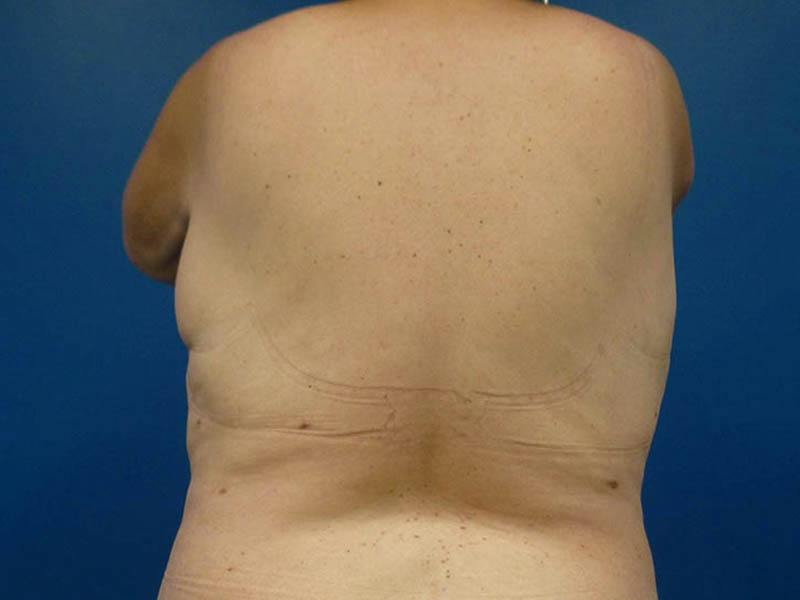 Liposuction Before & After Gallery - Patient 196680 - Image 2