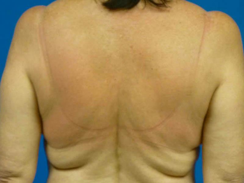 Liposuction Before & After Gallery - Patient 138909 - Image 1