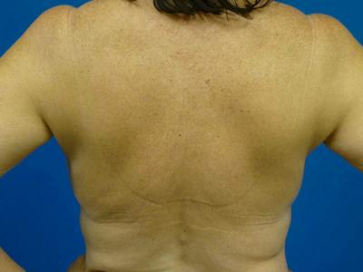 Liposuction Before & After Gallery - Patient 138909 - Image 2