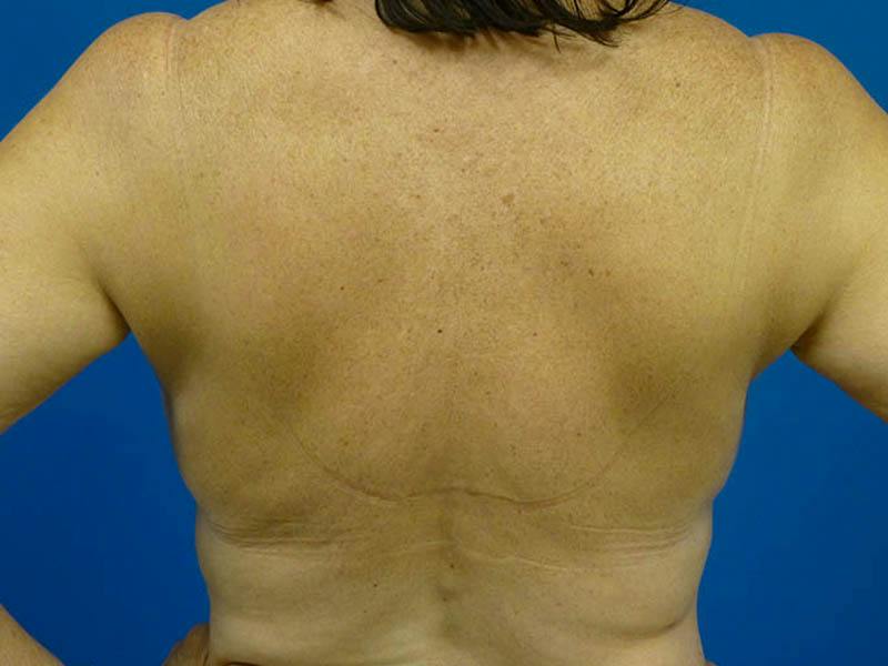 Liposuction Before & After Gallery - Patient 138909 - Image 2