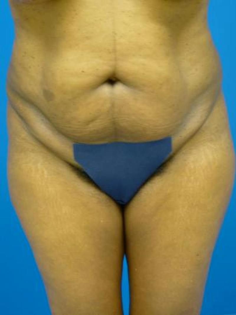Liposuction Before & After Gallery - Patient 817967 - Image 1