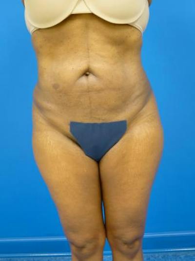 Liposuction Before & After Gallery - Patient 817967 - Image 2