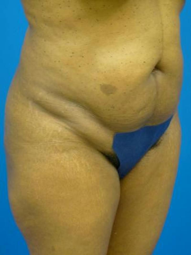 Liposuction Before & After Gallery - Patient 817967 - Image 3
