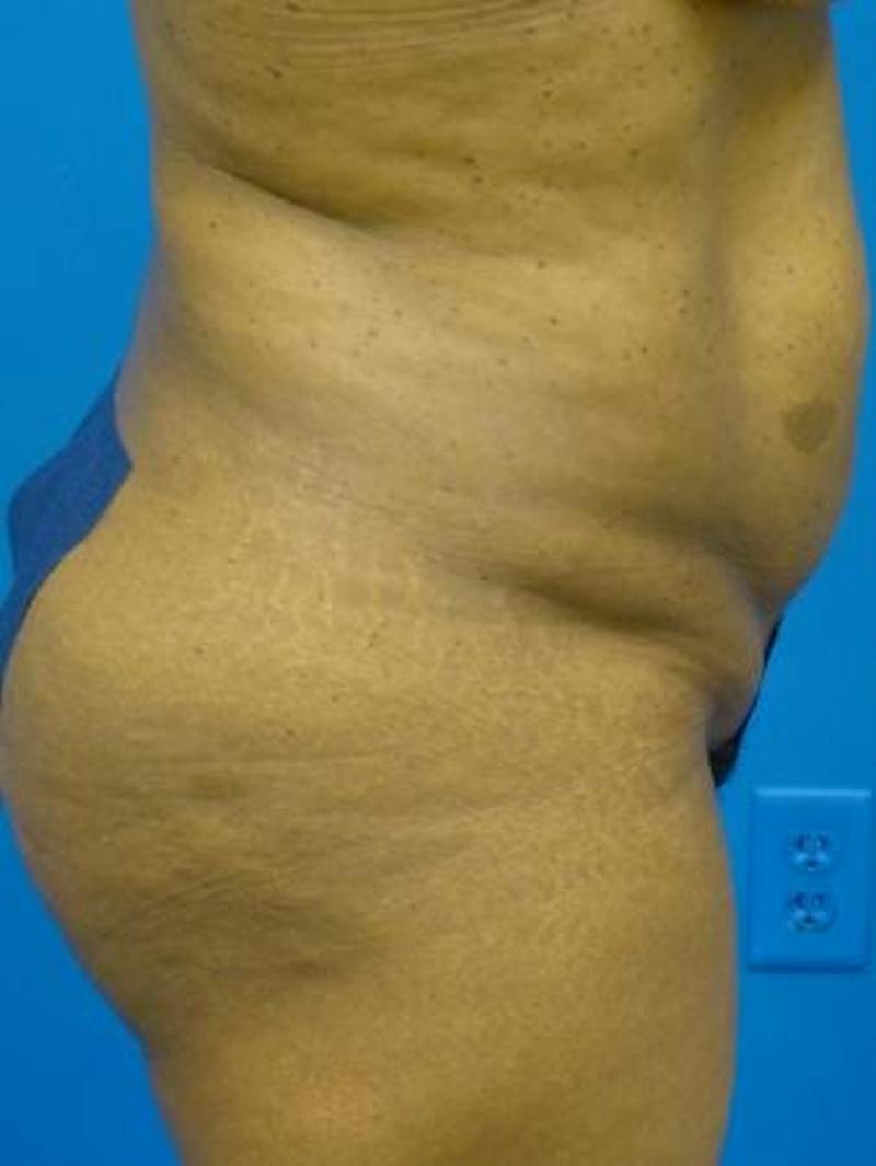 Liposuction Before & After Gallery - Patient 817967 - Image 5