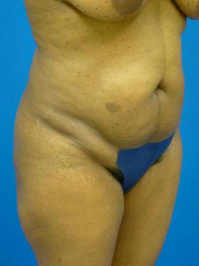 Liposuction Before & After Gallery - Patient 340904 - Image 1